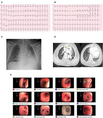 Disruption of cardio-pulmonary coupling in myopathies: Pathophysiological and mechanistic characterization with special emphasis on nemaline myopathy